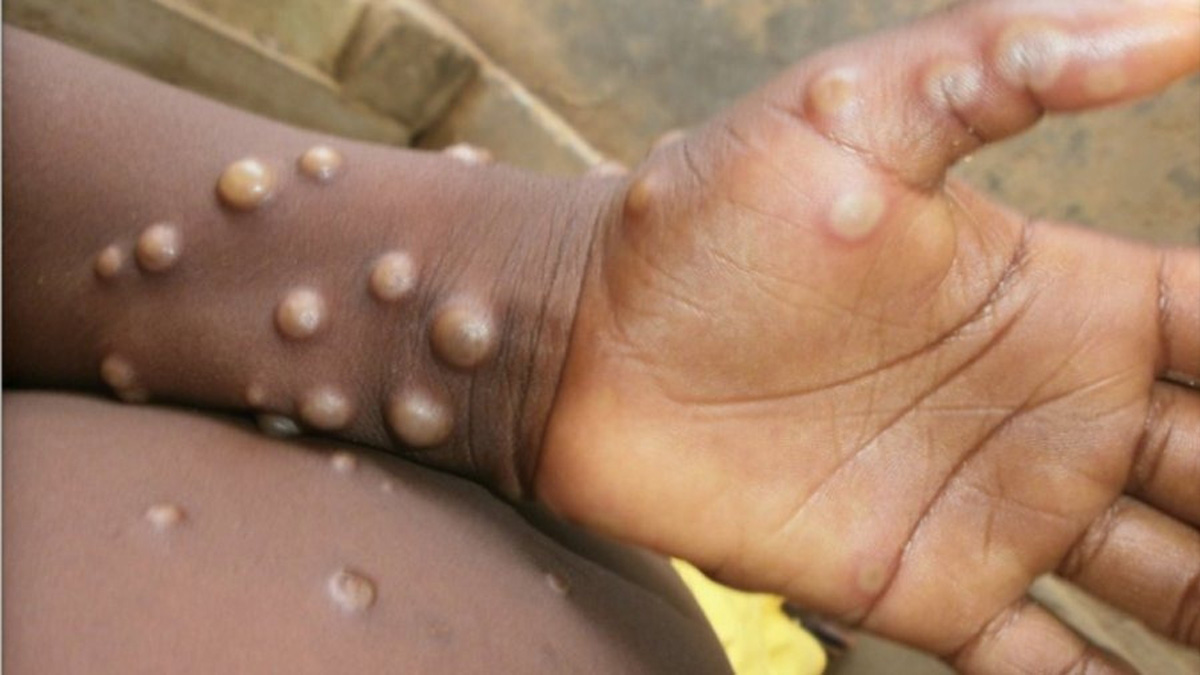 Monkeypox Virus , Monkeypox , Health , Study , Research , Researches , Symptoms Monkeypox Virus , MonkeyPox Disease , Monkeypox Symptoms , MonkeyPox Cures