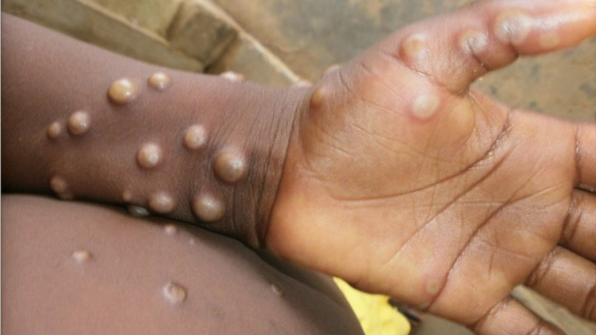 Monkeypox Virus , Monkeypox , Health , Study , Research , Researches , Symptoms Monkeypox Virus , MonkeyPox Disease , Monkeypox Symptoms , MonkeyPox Cures, Monkeypox Vaccine, Argentina