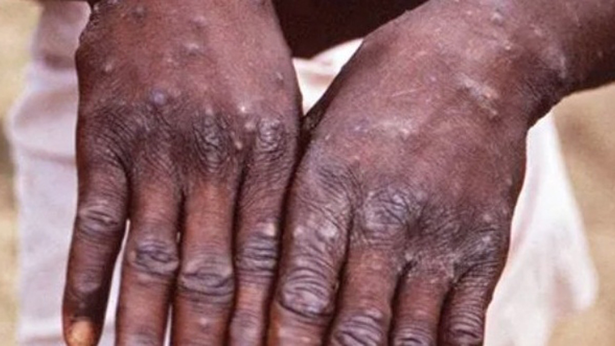 Monkeypox Virus , Monkeypox , Health , Study , Research , Researches , Symptoms Monkeypox Virus , MonkeyPox Disease , Monkeypox Symptoms , MonkeyPox Cures