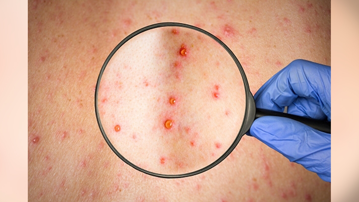 Health, UK Health Security Agency, UKHSA, Monkeypox