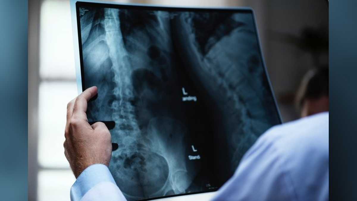 Health, Study, London, Research, Researchers, World News, Spinal Cord, Spinal Cord Injury