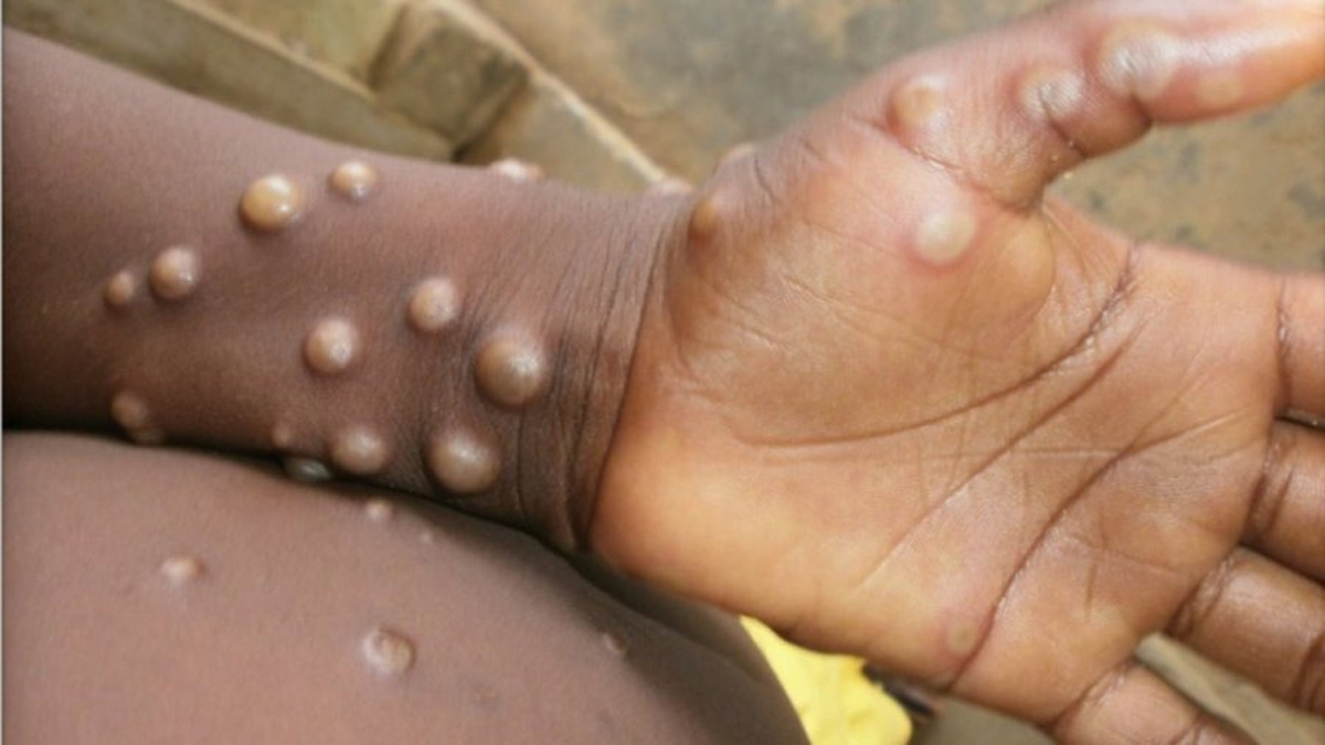 Monkeypox Virus, Monkeypox, Health, Study, Research, Researches, Symptoms Monkeypox Virus, MonkeyPox Disease, Monkeypox Symptoms, MonkeyPox Cures