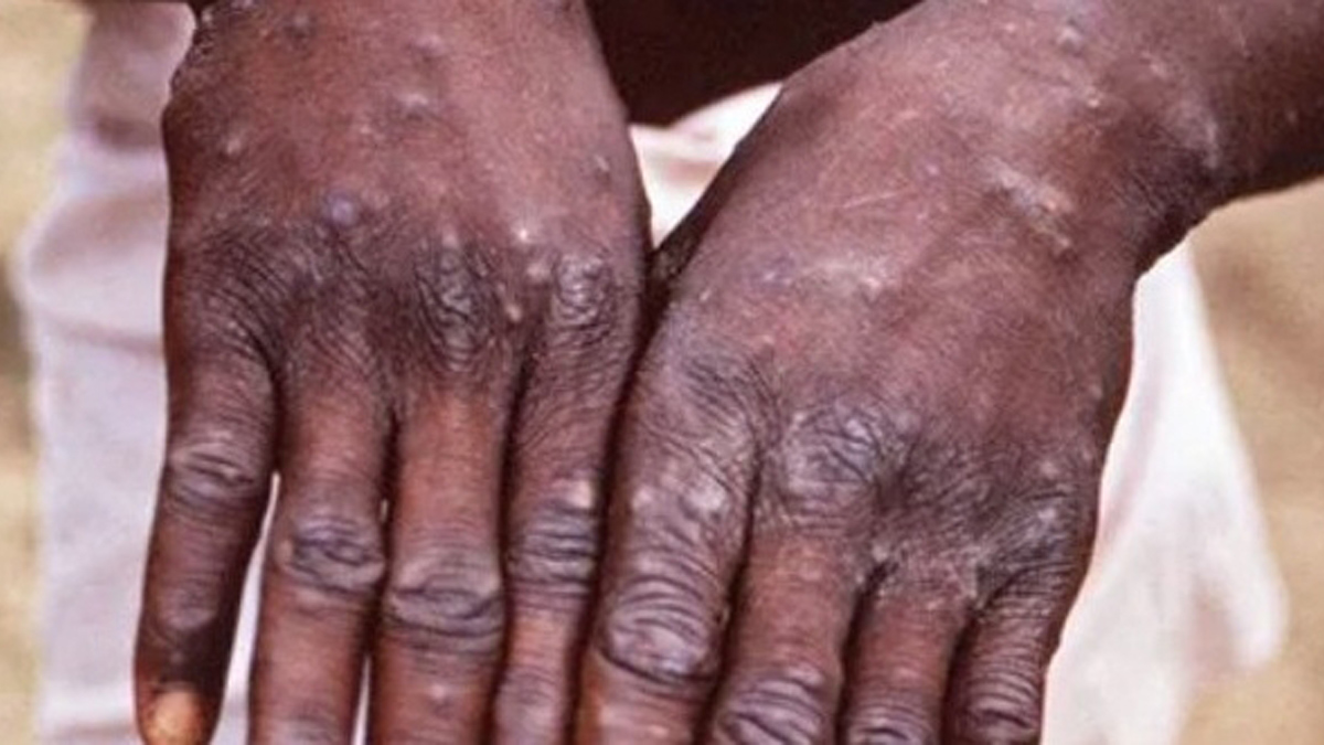 Monkeypox Virus , Monkeypox , Health , Study , Research , Researches , Symptoms Monkeypox Virus , MonkeyPox Disease , Monkeypox Symptoms , MonkeyPox Cures, Monkeypox News WHO