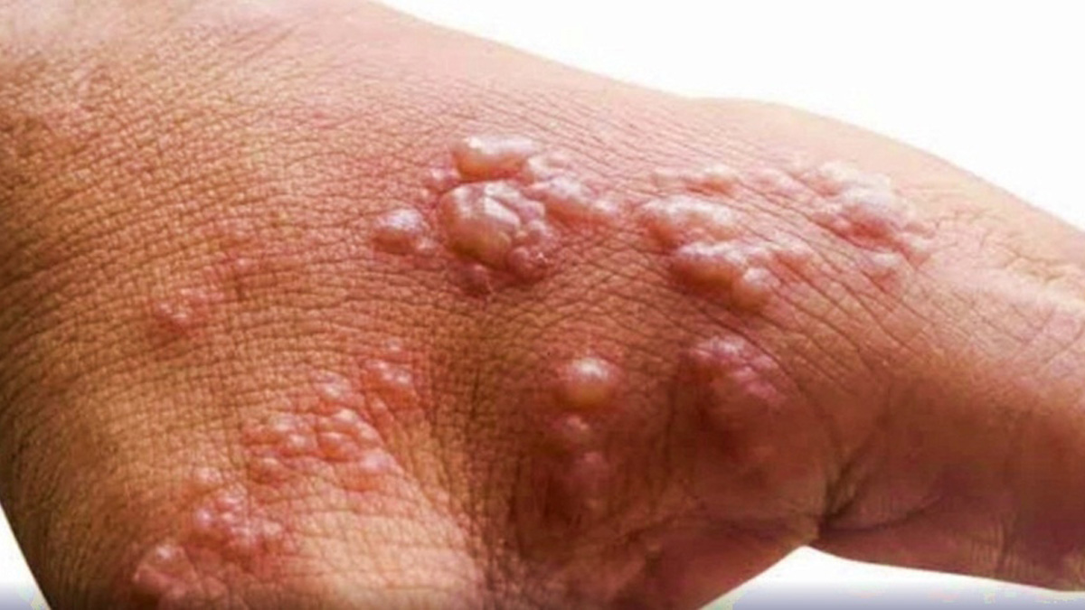 Monkeypox Virus , Monkeypox , Health , Study , Research , Researches , Symptoms Monkeypox Virus , MonkeyPox Disease , Monkeypox Symptoms , MonkeyPox Cures, Monkeypox Cases In India, Monkeypox Cases, Monkeypox India