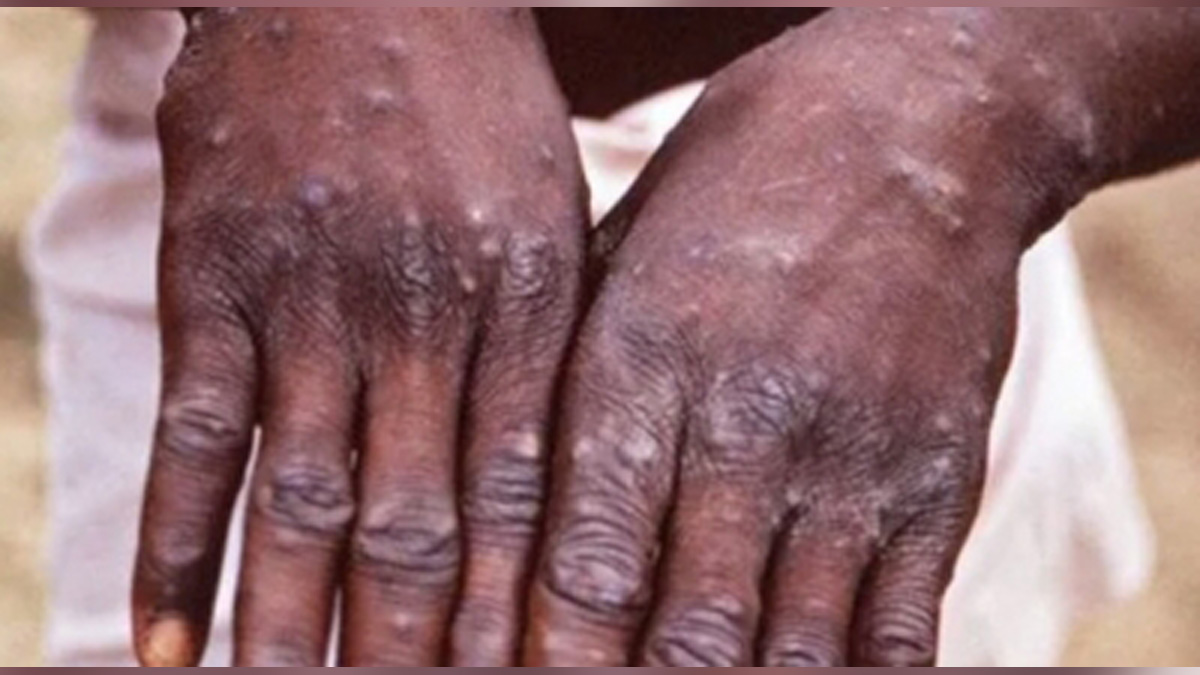 Monkeypox Virus, Monkeypox, Health, Study, Research, Researches, Symptoms Monkeypox Virus, MonkeyPox Disease, Monkeypox Symptoms, MonkeyPox Cures