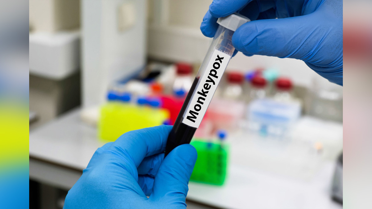 Health, Monkeypox Virus, Monkeypox, Health, Study, Research, Researches, Symptoms Monkeypox Virus, MonkeyPox Disease, Monkeypox Symptoms, MonkeyPox Cures