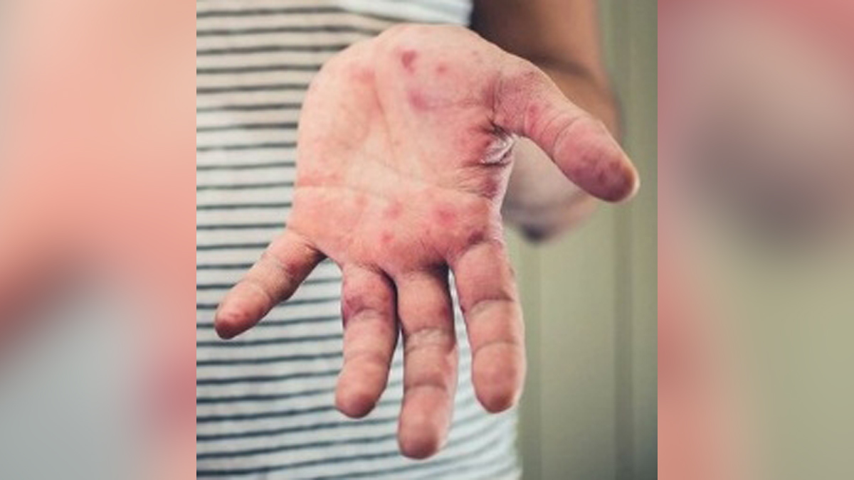 Health, Tomato Flu, Hand Foot Mouth Disease, HFMD, Lucknow, Uttar Pradesh