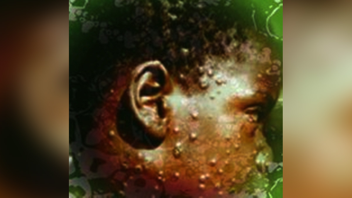 Monkeypox, Health, Monkeypox Virus, Symptoms Monkeypox Virus, MonkeyPox Disease, Monkeypox Symptoms, MonkeyPox Cures, Monkeypox Scare