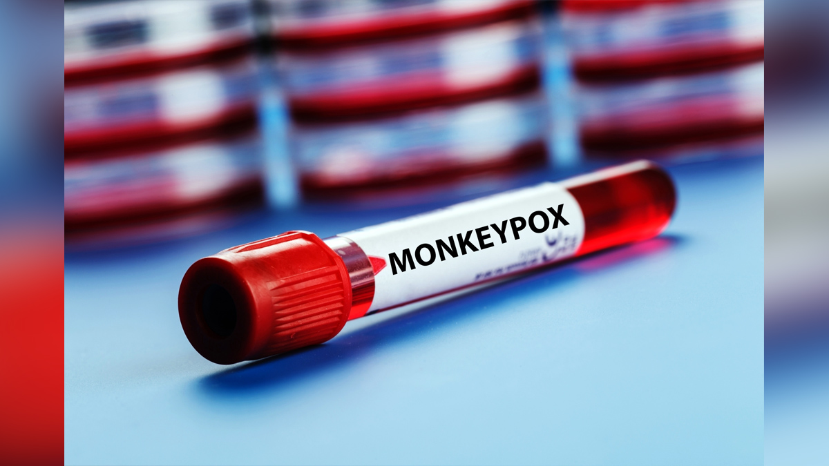 Monkeypox, Health, Monkeypox Virus, Symptoms Monkeypox Virus, MonkeyPox Disease, Monkeypox Symptoms, MonkeyPox Cures, Monkeypox Scare, Thiruvananthapuram