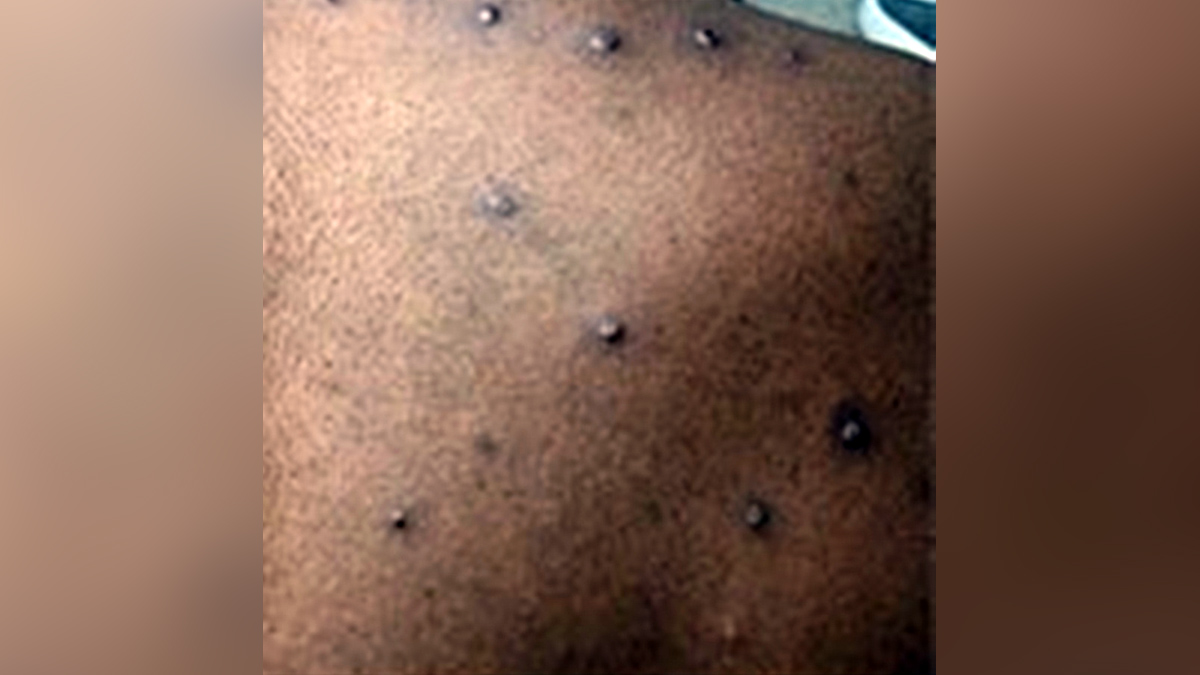 Monkeypox, Health, Monkeypox Virus, Symptoms Monkeypox Virus, MonkeyPox Disease, Monkeypox Symptoms, MonkeyPox Cures,Monkeypox scare