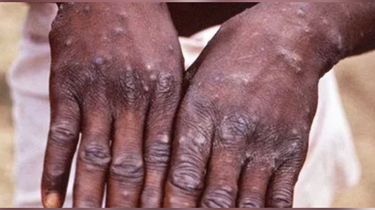 Health, Monkeypox Virus, Monkeypox, Health, Study, Research, Researches, Symptoms Monkeypox Virus, MonkeyPox Disease, Monkeypox Symptoms, MonkeyPox Cures