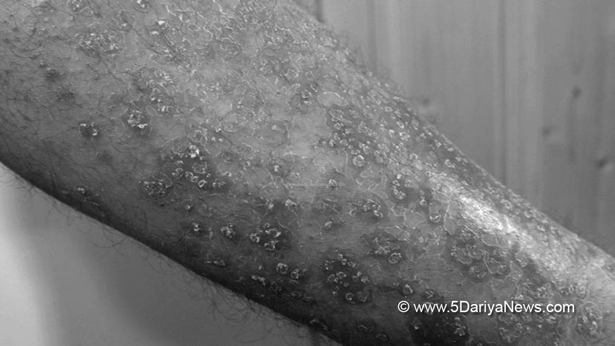 Health, Research, Psoriasis, Obesity, Metabolic Liver Disease, Obesity risk in psoriasis patients, Psoriasis study 2025